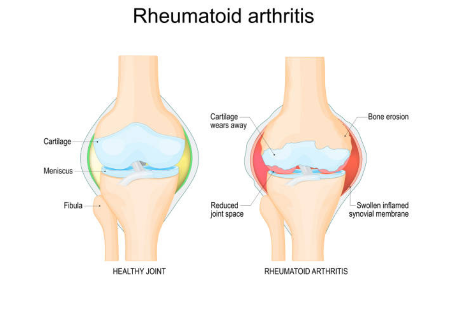 healthmedicus.com-blog-disease-rheumatoid-arthritis-1.png